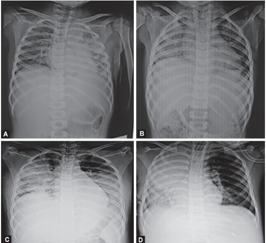 JaypeeBrother's tweet photo. Invasive Pneumococcal Disease Case Series in Pediatric Inpatients: A Clinical Experience from South India https://t.co/SiLUjNbfvd #Invasivepneumococcaldisease #Pediatric #Serotype #Vaccine #RajagopalKishoreKumar #VijayNYewale #JaypeeJournals https://t.co/EFamVLUQPe