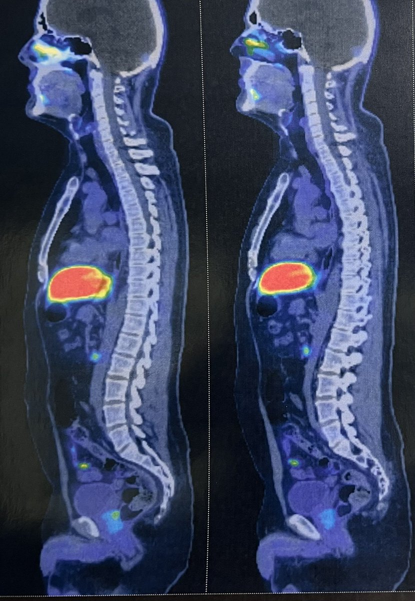 RomanCarvajal's tweet photo. Las tablas predictivas no son tan precisas, PETCT PSMA sin actividad extra próstata, con PSA 33ng, 11 de 12 biopsias +, 4+3 patrón cribiforme. #prostatecancer #PETCTPSMA https://t.co/UJysEAwpUI