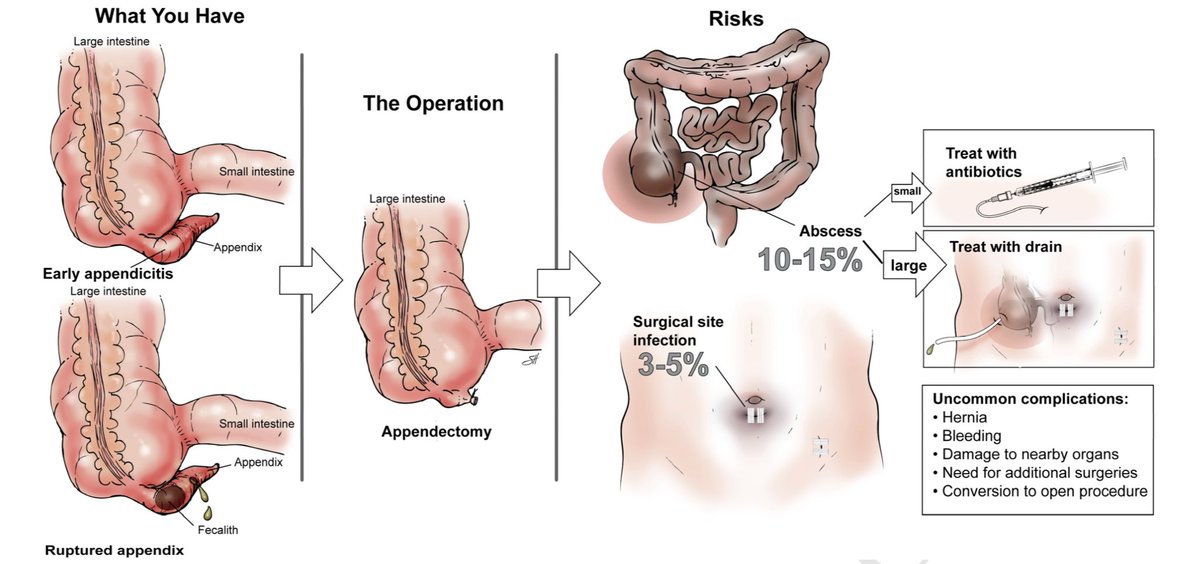 almagoch's tweet image. Si el #VisualAbstract le ayuda a lo #Médicos a entender mejor un artículo, seguramente le ayudará también a los pacientes a entender mejor su consentimiento informado, cómo lo demuestra está publicación del @AmJSurgery 👉🏻americanjournalofsurgery.com/article/S0002-… #VisualConsent #Cirugía