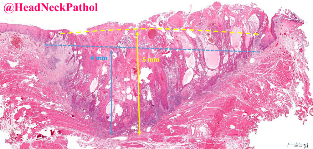 Variability in Depth of Invasion Measurements in Carcinomas of the Oral Cavity and the Effect on Pathologic Tumor Staging
By Allen-Proctor, Rahman, Reddy, et al.
rdcu.be/cORwv
#HeadNeckPathol #HNPJ #HeadandNeckPath #Pathology #ENTPath #PathologyTweet