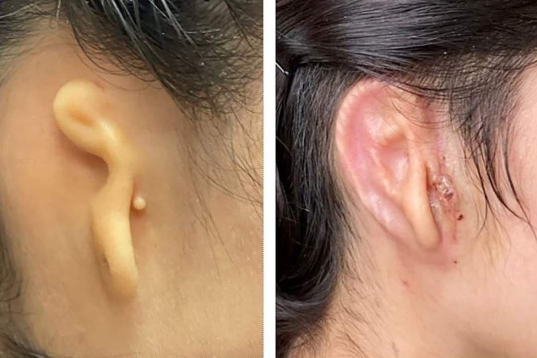 ROEUpdates's tweet photo. Doctors in the US transplants 3D Printed Ear Made of Human Cells in a 20 years old woman.
File photo: The new York times
 #Medical #ear #3d #roeupdates #FYP https://t.co/rWsz61NiQH