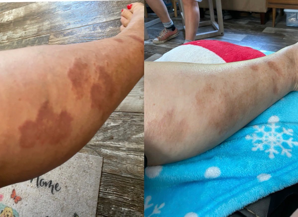 AmeriCannaBlunt's tweet photo. The image on the (right) is before applying TERPS TOUCH,
the image on the left is 2 min after applying TERPS TOUCH.
#eczema
Next:
The image on the left is before applying TERPS TOUCH.
The image on the right is 3 1/2 min after applying #TERPS TOUCH.
#GranulomaAnnulare
#AskTERPS https://t.co/8JmJLDMRna