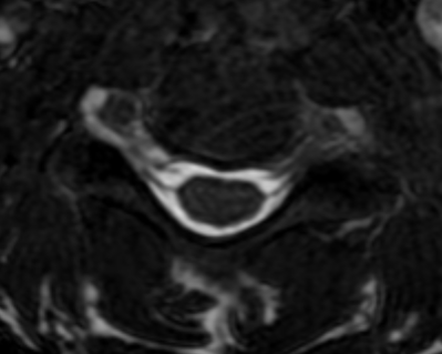 DrNeetigpt's tweet photo. I see an uncanny resemblance between this sloth from Ice age and the axial section of the cervical canal for brachial plexus MRI...😋
Do you??
#msk #cartoon #radfun https://t.co/jQ8XpoXVxw