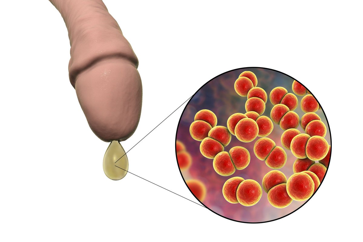 Bismillaah...
Suatu ketika sy kedatangan pasien seorang pria muda yg mengeluh nyeri di Mr. P nya sej...
