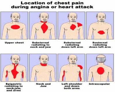 Understanding Upper Back and Chest Pain