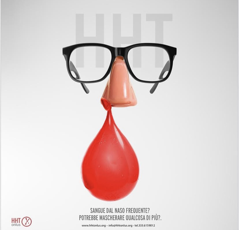 Giugno è il mese mondiale per la sensibilizzazione della Teleangiectasia Emorragica Ereditaria, in inglese HHT. 
Ecco le iniziative di HHT Onlus e i consigli per riconoscere i sintomi di una malattia che spesso è molto difficile da individuare