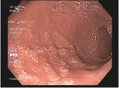 Rare #GIpathology 53 M gastric body "inflammation".  Histology shows lamina propria accumulation of histiocytes with coarsely granular and pigmented material. #PathTwitter <a href="/MedEd/">Azzat</a>  <a href="/NYUGSOMpathres/">NYUGSOM Pathology Residency</a>