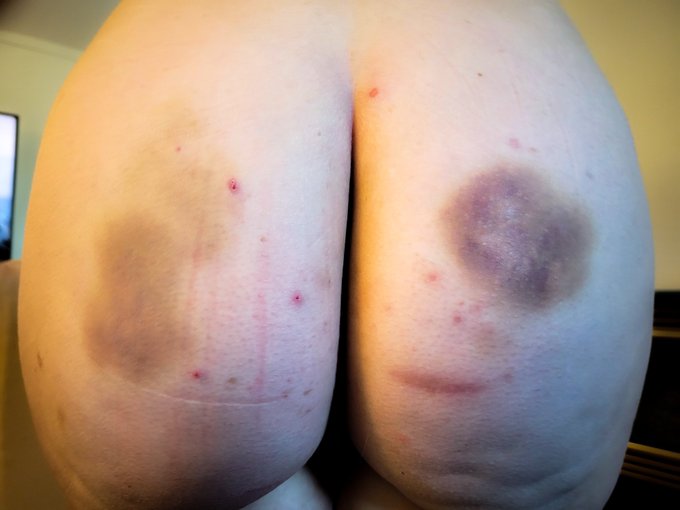 Update:  my spanking marks are really coming in now! 😅 https://t.co/PNd4fds85V