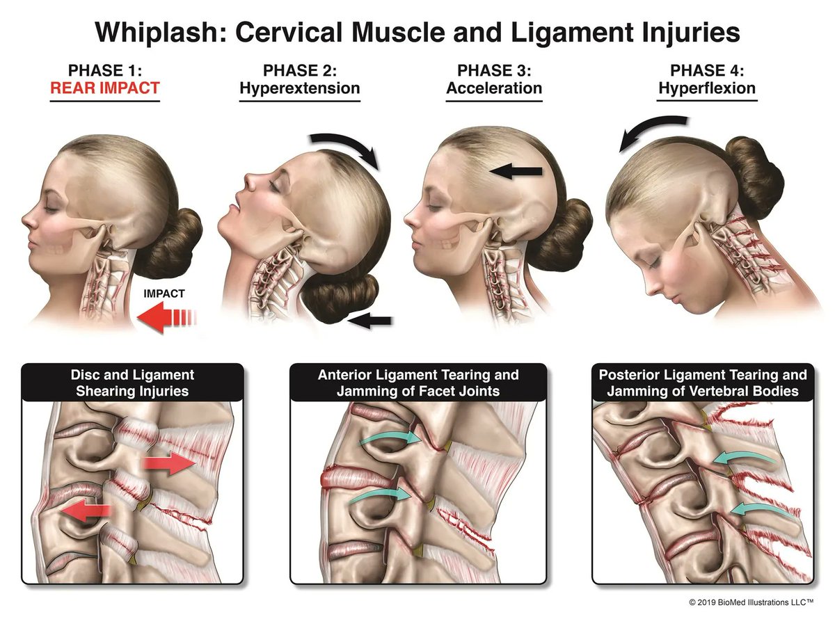 Medillustrates's tweet photo. "Whiplash: Cervical Muscle and Ligament Injuries," illustrated by BioMed Illustrations, LLC, a #medicallegal #illustration company founded by Aimée L. Cammilleri, MA, CMI, a Board Certified Medical Illustrator.

Explore more: https://t.co/jeWBLOph3z

#whiplash #medicalvisuals https://t.co/Ur7NemRJ3M