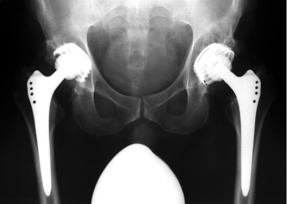 jbjs's tweet photo. Updated #JBJSClinicalSummary on Total #Hip #Arthroplasty and Hip #Dysplasia #THA
By: Tad M. Mabry, MD
https://t.co/Gy415tKwH4 https://t.co/0Hgtqsv6Yz