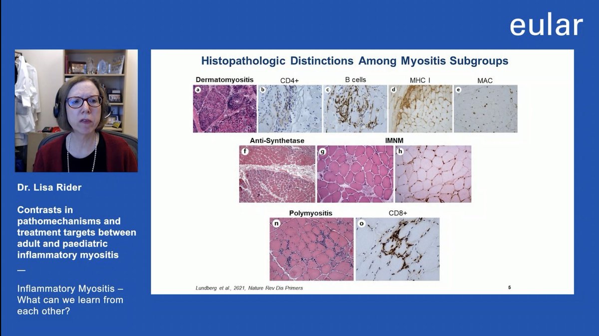 AshimaMakol's tweet photo. ✨ Inflammatory #Myositis✨

👉 Excellent summary of Autoantibodies, Immune alterations and Distinct Phenotypes by Dr. Lisa Rider

#EULAR2022 https://t.co/KLzmLUGk9Z