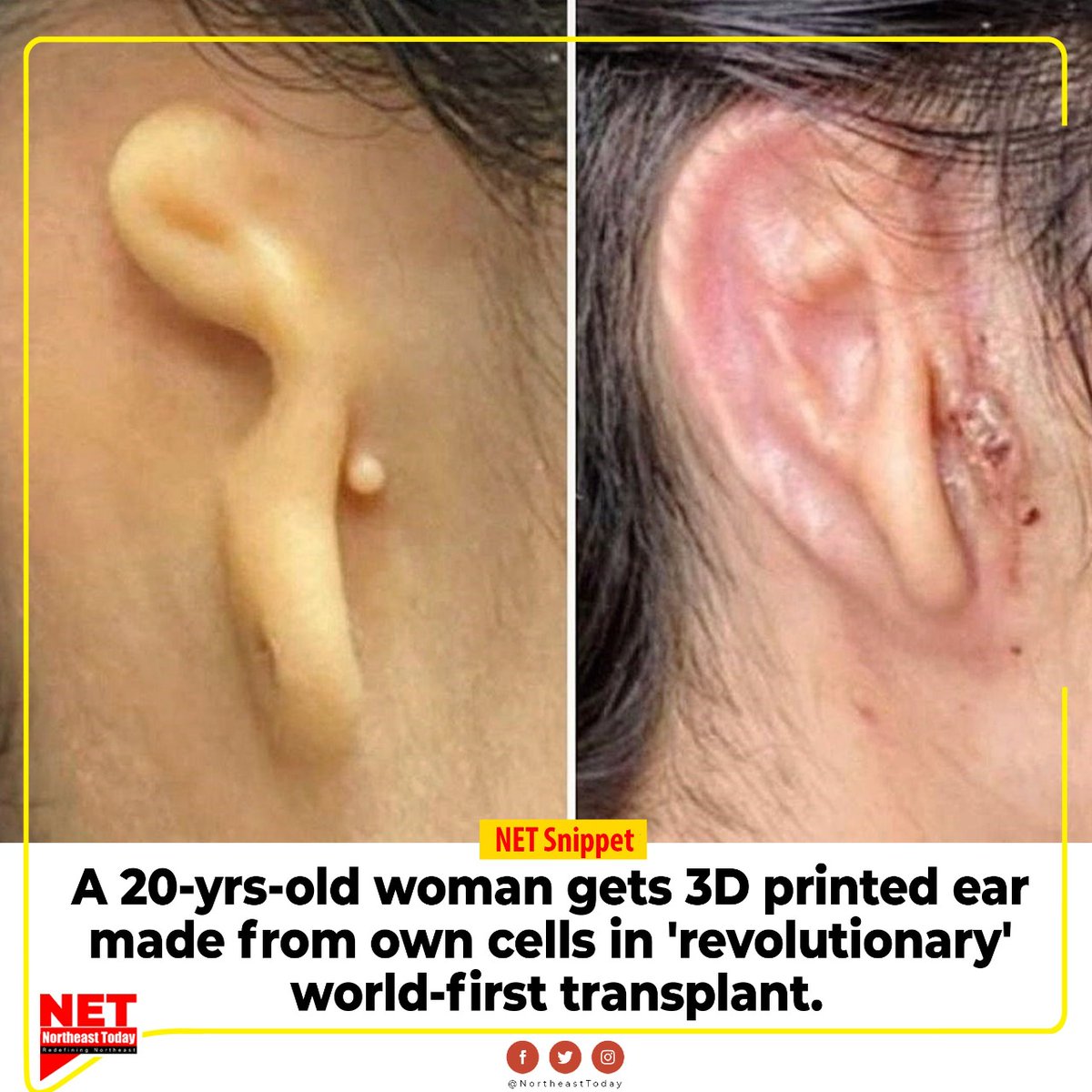 NortheastToday's tweet photo. #NetSnippet | A significant achievement in the field of medical sciences, a 20-year-old woman received a 3D printed ear, which is made from her own cells.
The woman was said to be born with a misshapen and a small right ear.
#3d #3Dprintedear #implantsurgery #3DBioTherapeutics https://t.co/NyDkSdP9En