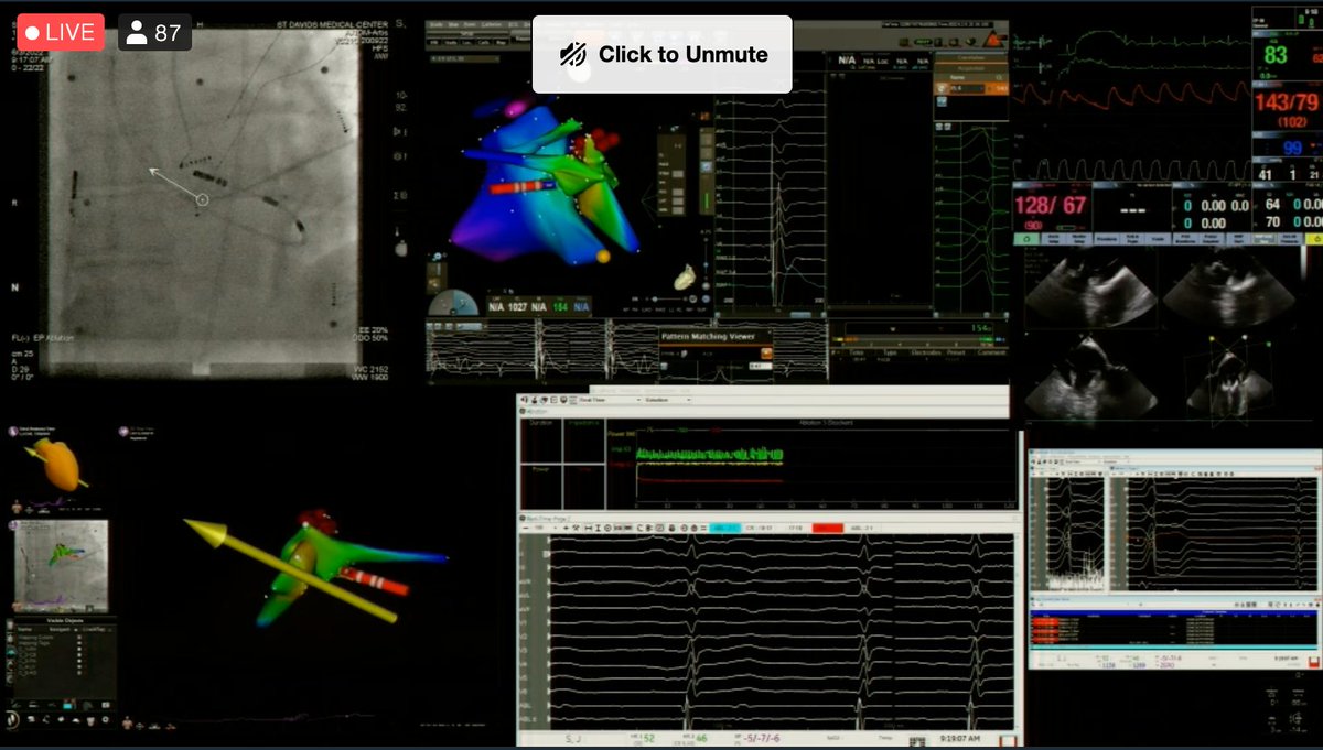 Dr. Devi G Nair (@drdevignair) on Twitter photo Live case - Cusp PVC ablation with <a href="/Stereotaxis/">Stereotaxis</a> in conjunction with the use of 4D Nuvision ICE catheter by Dr. David Burkhardt at #EPLiveAustin2022 <a href="/natale_md/">Andrea Natale MD</a> <a href="/LuigiDiBiaseMD/">Luigi Di Biase</a> <a href="/Dr_Santangeli/">Pasquale Santangeli</a> @BiosenseWebster Live case - Cusp PVC ablation with <a href="/Stereotaxis/">Stereotaxis</a> in conjunction with the use of 4D Nuvision ICE catheter by Dr. David Burkhardt at #EPLiveAustin2022 <a href="/natale_md/">Andrea Natale MD</a> <a href="/LuigiDiBiaseMD/">Luigi Di Biase</a> <a href="/Dr_Santangeli/">Pasquale Santangeli</a> @BiosenseWebster