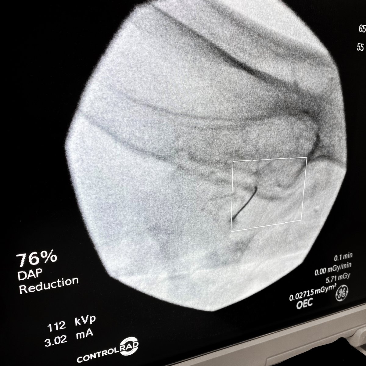 Whether it be multiple injections in the spine, knee, or SI joint, Dr. Hunter Boyett and his staff at The Orthopedic Center in Athens, AL reduce their radiation by at least 76% in these procedures without compromising image quality using ControlRad Trace. ControlRad.com