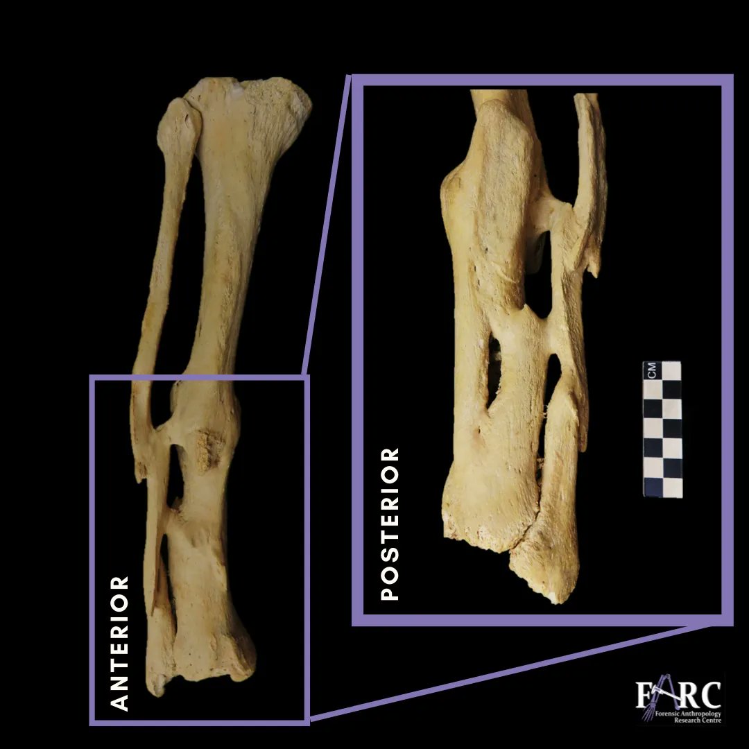 #wtFARCfriday 
Ever wonder what happens if you do not properly set a broken bone? 🦴
Sometimes the #brokenbones will not properly align and heal, leading to #malalignment after treatment. This could cause limb shortening and further complications to the patient. 
#healedtrauma
