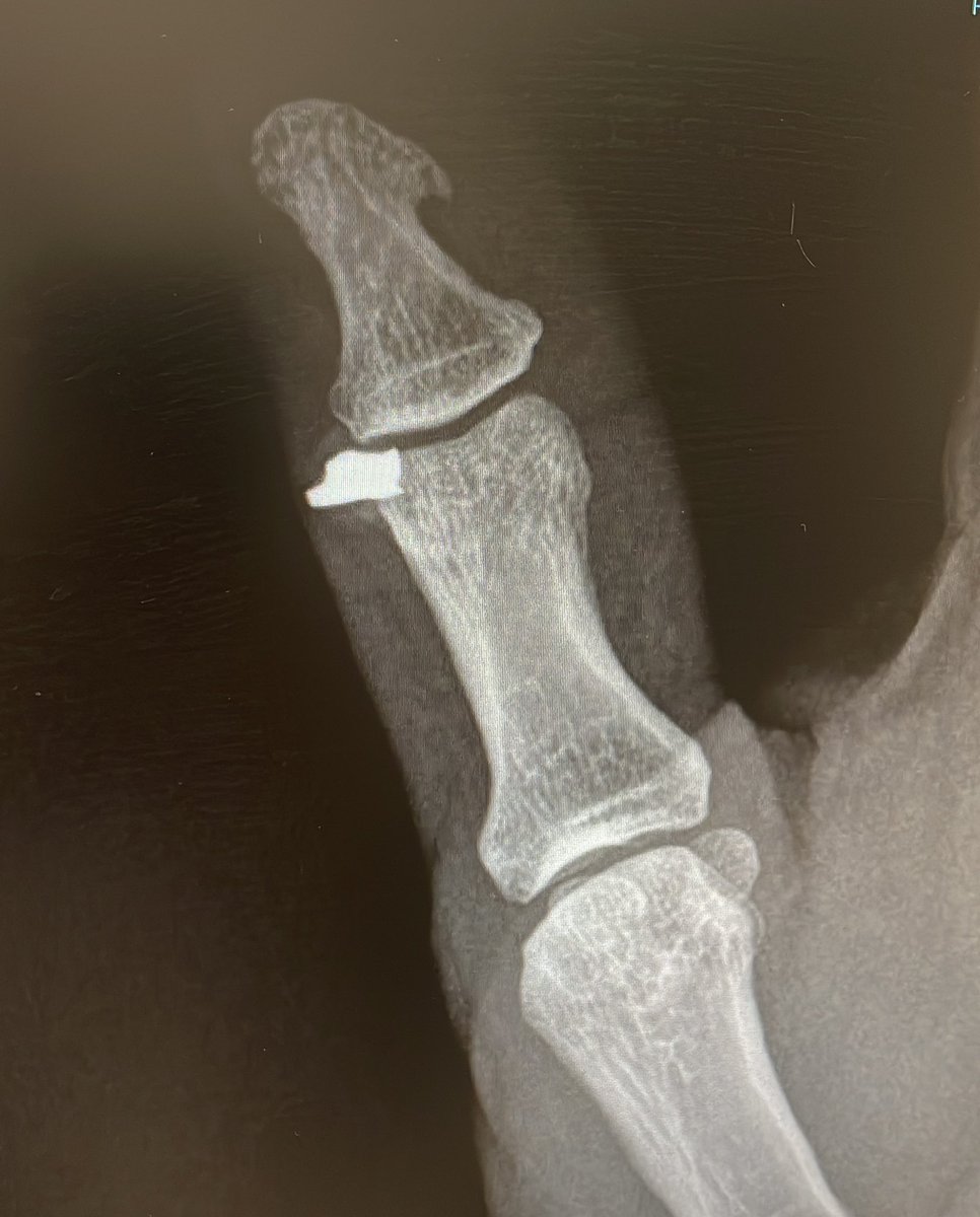 Uso de EPI: Guantes de protección SIEMPRE!!
Esquirla metálica tras corte de chapa en articulación interfalángica distal. Porción de esquirla clavada en espesor de hueso. Resolución quirúrgica. Jamás os confiéis. (Foto publicada con consentimiento del paciente)