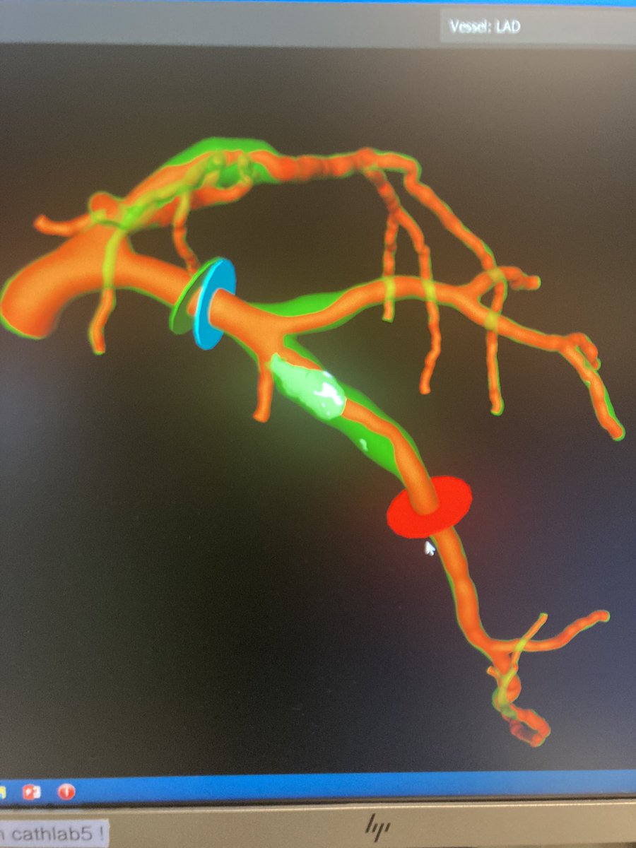 ColletCarlos's tweet photo. Today we had the privilege to show the new generation of coronary physiology #ppg @coroventis and #mrr live at #opci with novel method for imaging guided  PCI #ctguidedpci  @HeartFlow 

Fantastic team work with @jeroen_sonck @belmontemarta1 @EGallinoro @BernardBruyne https://t.co/Gr5tp94Grr