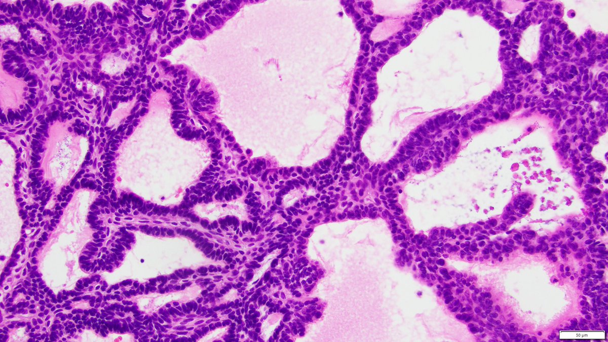 60M, destructive maxillary sinus lesion, diagnosis/DDx? #ENTPath #HeadandNeckPath #PathTwitter #HeadNeckPathol #pathology #PathologyTweet