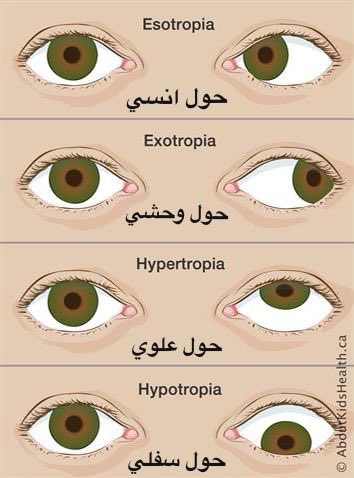 POphtha's tweet photo. الحول: هو فقدان التوازي بين العينين، إذ لا تكون محاذاتهما في نفس الاتجاه عند النظر إلى جسم ما.

يمكن أن يحدث الحول:

- قبل عمر ال٦ أشهر ويسمى (الحول الخُلقي)
- بعد الـ ٦ اشهر فيسمى (الحول المُكتسب)
⁃ خلال سن الرشد (حول البلوغ) https://t.co/KipFYkxdgo
