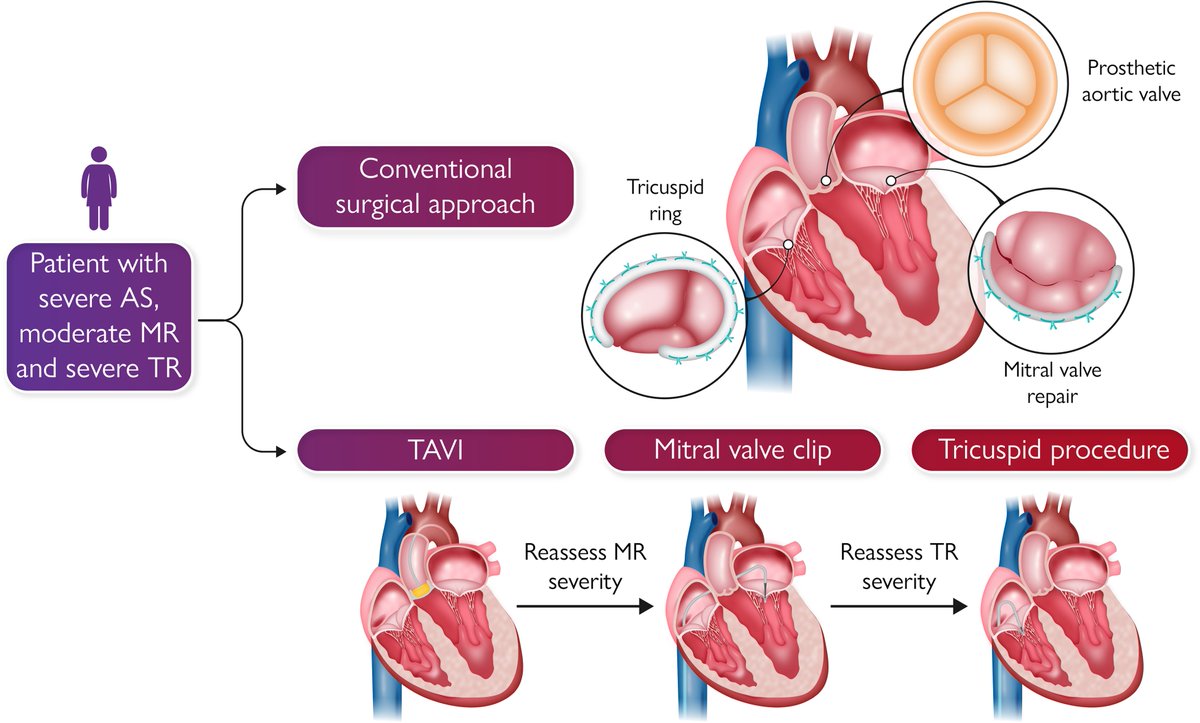 ottoecho's tweet photo. Transcatheter interventions spark a paradigm change for management of patients with mixed valve disease https://t.co/GdSISm5ObZ https://t.co/bDzI7F6FaL