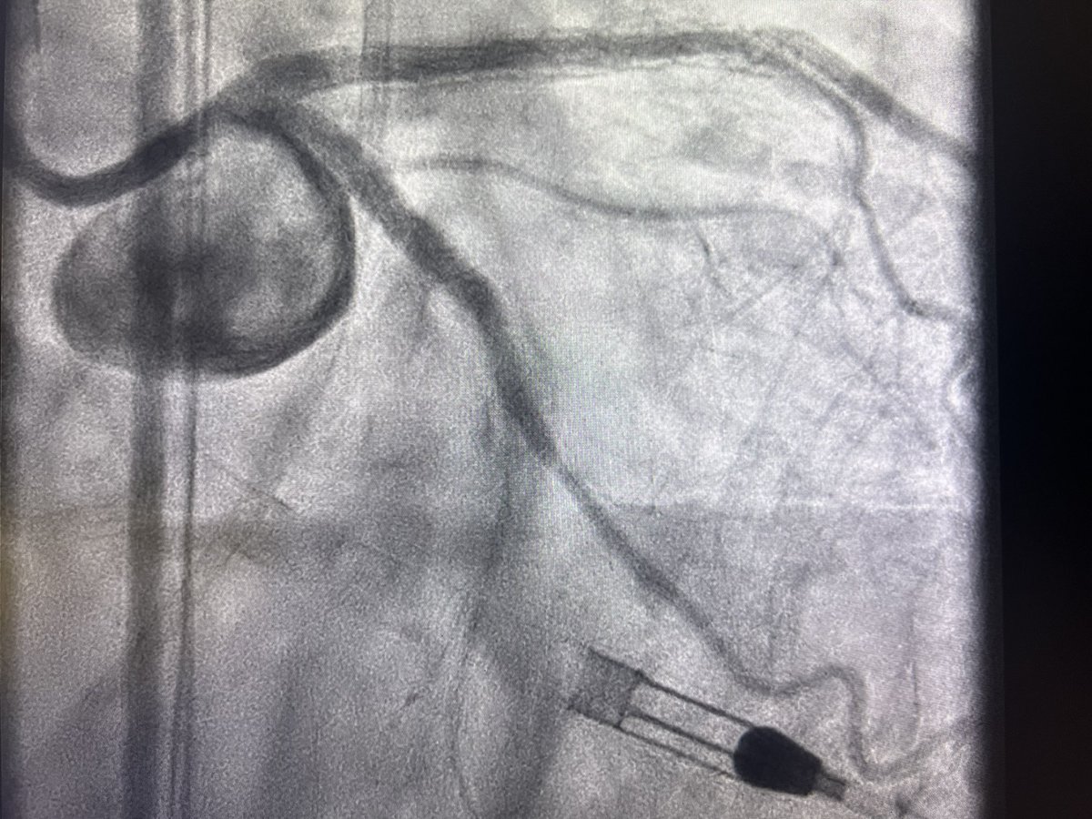 Great cases today for an advanced operators course.  PercAx LM DK crush case followed by Impella assisted IVL bifurcation LM case.  We needed the help of our guest colleagues for these cases. Thanks <a href="/NCVHonline/">New Cardiovascular Horizons</a> for the live case opportunity. Big props to St Johns cath lab staff!