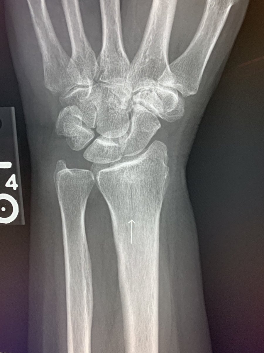 northwoods1980's tweet image. Yes sir. It’s a fracture.