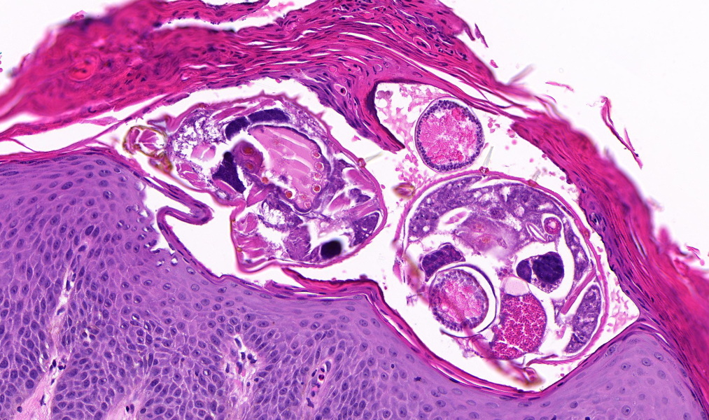 TristanRutland7's tweet photo. Crusted (Norwegian) scabies.

➡️Caused by Sarcoptes scabiei mite.

➡️Associated with immunosuppression:
e.g. the virus HTLV-1, which is sadly endemic in Indigenous Australians in central &amp; north Australia

#Dermpath #pathcritters #IDpath #dermatology #PathTwitter https://t.co/uinXKhD6zA