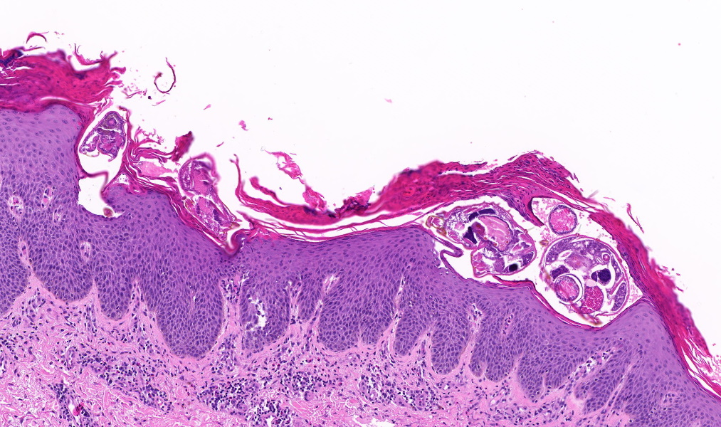 TristanRutland7's tweet photo. Crusted (Norwegian) scabies.

➡️Caused by Sarcoptes scabiei mite.

➡️Associated with immunosuppression:
e.g. the virus HTLV-1, which is sadly endemic in Indigenous Australians in central &amp; north Australia

#Dermpath #pathcritters #IDpath #dermatology #PathTwitter https://t.co/uinXKhD6zA