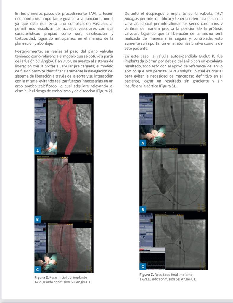 TeamHermosillo's tweet photo. Conoce a uno de nuestros doctores, el doctor Jorge Cortes Lawrenz, cardiólogo intervencionista y Director de Hermosillo Heart Team en el Hospital CIMA,  con su artículo: TAVI Analysis como guía en fusión 3D en Angio TC durante implante TAVI. https://t.co/W61xjugeFu