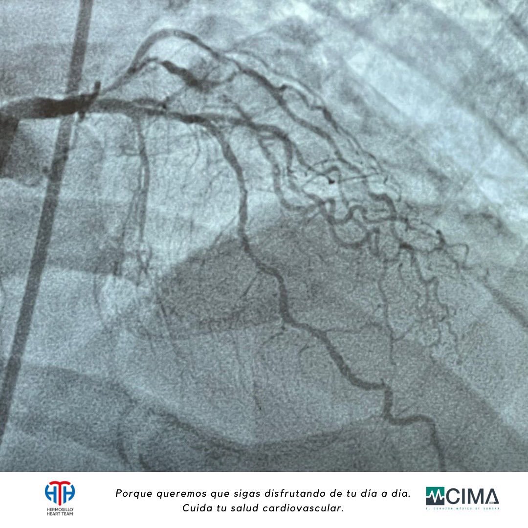 TeamHermosillo's tweet photo. Ayer de nuevo Hermosillo Heart Team y Hospital CIMA hacen  historia en el Noroeste. Posicionándose como  el primer centro donde se hace litoplastia intracoronaria Indicada en estenosis calcificadas de las arterias coronarias.
HHT y Hospital cima siempre a la vanguardia. https://t.co/qOTwe4GxKh