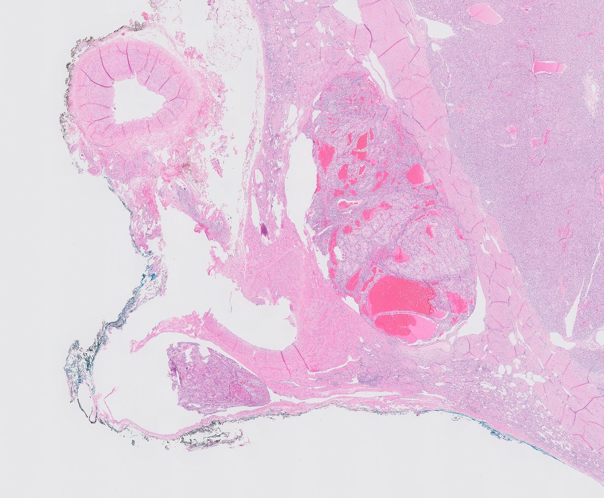 chemily7's tweet photo. Remember to look for vein invasion in your partial nephrectomies! What was thought to be a multinodular tumor (left) clearly showed tumor in a major (segmental) vein on b2b (right). Likely call-able w/o b2b but wanted to teach trainee to look for vessel margins on gross #gupath https://t.co/Rqn4FaWciZ