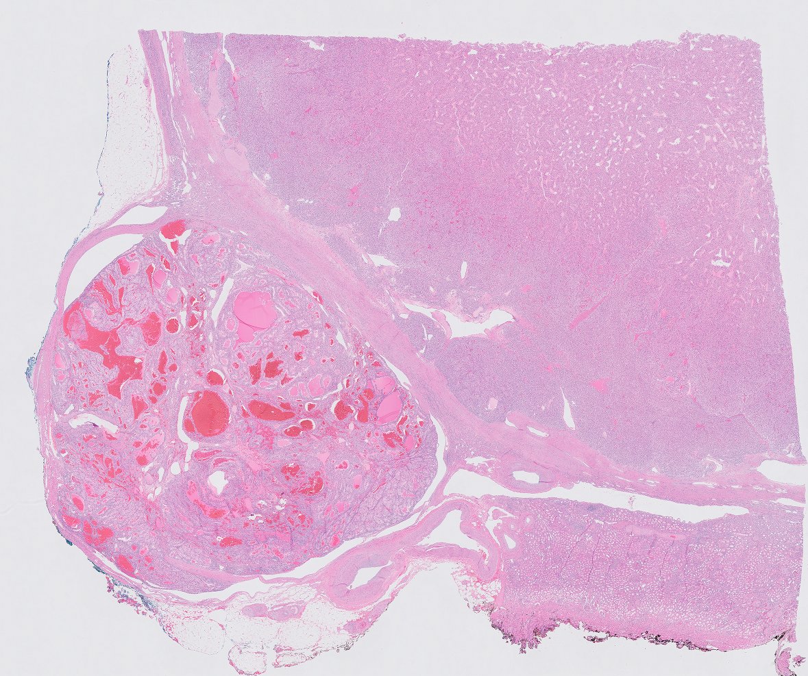 chemily7's tweet photo. Remember to look for vein invasion in your partial nephrectomies! What was thought to be a multinodular tumor (left) clearly showed tumor in a major (segmental) vein on b2b (right). Likely call-able w/o b2b but wanted to teach trainee to look for vessel margins on gross #gupath https://t.co/Rqn4FaWciZ