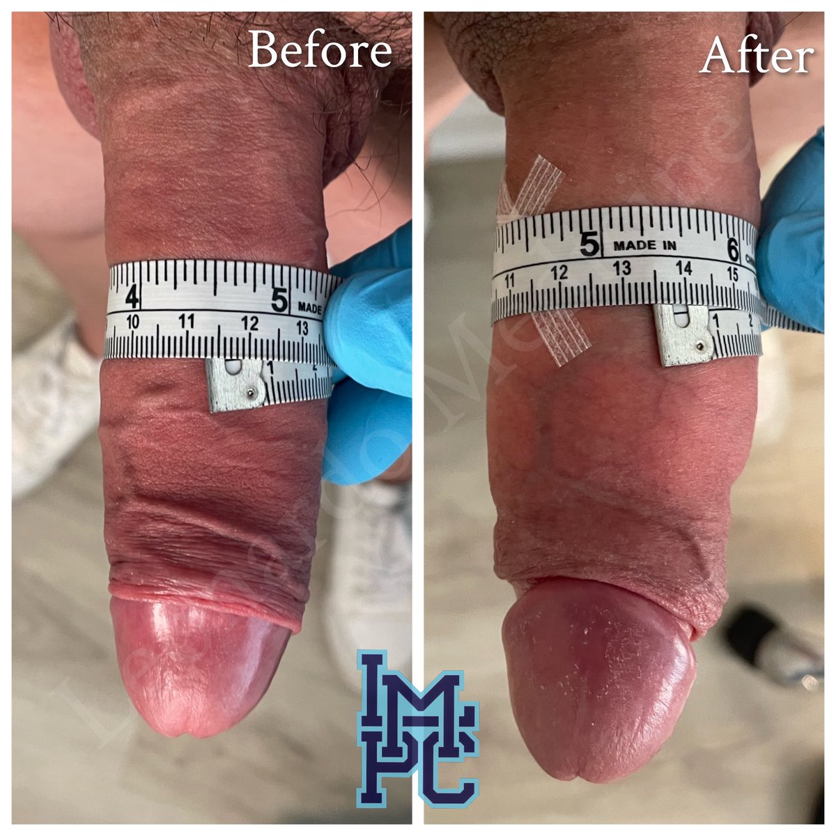 JLeonardoMD's tweet photo. #penileaugmentation #penileaugmentationbydrleonardo #maleenhancement #penisfiller #youonlybigger https://t.co/tNjZVvsXcz