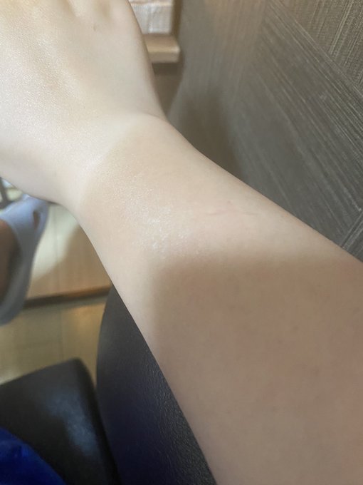 日焼けしてしまった😭 https://t.co/H0kImj72gm