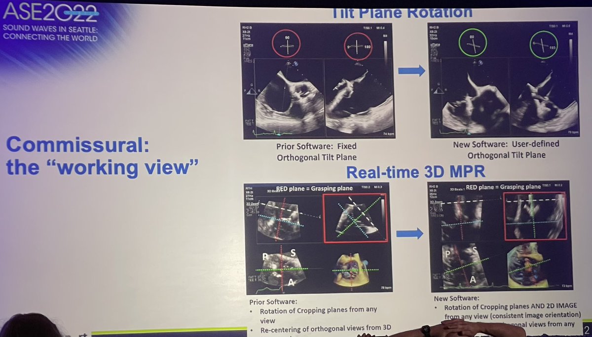 Learned a lot about tricuspid valve imaging by TEE at ASE #ASE2022 @hahn_rt @SLittleMD @gb_mackensen @CynthiaTaub @RigolinVera