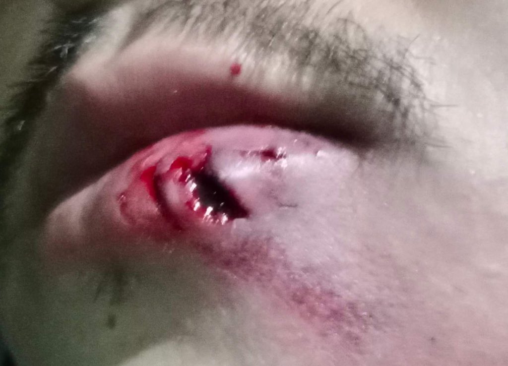 TW: Blood, wound🚨🚨🚨
.
.
.
.
.
.
เพื่อนของผู้บาดเจ็บส่งรูปนี้มาให้เรา เขาโดนยิงในม็อบวันนี้ (จากกระสุนยางหรือลูกแก้วไม่แน่ใจ) ตามหลักแล้วในการสลายการชุมนุมหากใช้ปืน จนท.ต้องเล็งในช่วงล่างตั้งแต่เอวลงไป เราคิดว่ามวลชนคนนี้คงไม่ได้นอนอยู่ตอนจนท.ยิงอ่ะนะคะ 
#ม็อบ11มิถุนายน65