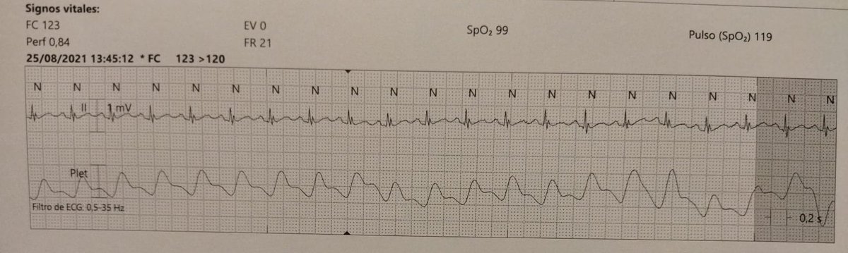 Este varón ingresó por ictus en región bulbar lateral, que le produjo un síndrome de Wallemberg. Además de la famosa clínica, presentó taquicardia sinusal incesante en la telemetría. ¿Motivo? La lesión del núcleo del N. Vago (X) suprimió la estimulación parasimpática del corazón.