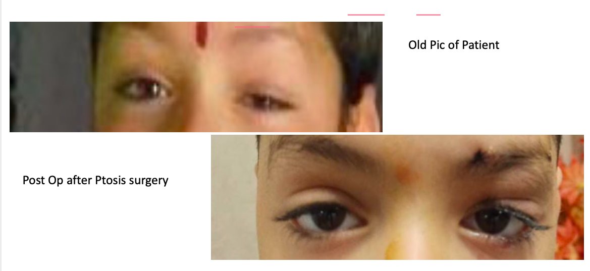 Gratifying experience for a surgeon to see smile on parents' face after Ptosis surgery of their child, good results achieved🙂@ssphpgti@pgich
