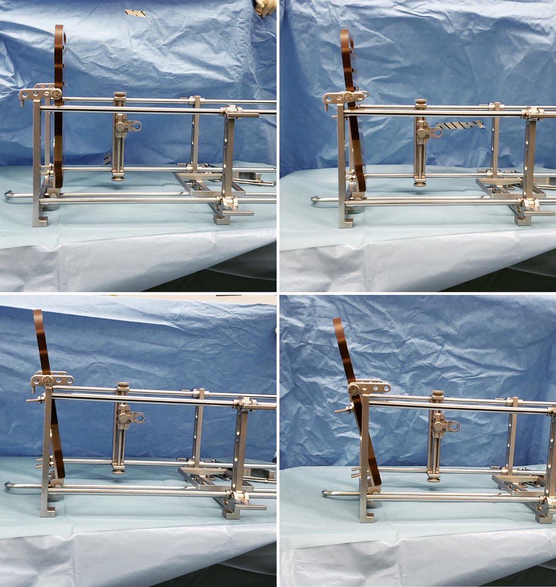 GonzaloBastias's tweet photo. Ankle arthritis w/equinus deformity can be challenging. We take advantage of the frame positioning the foot plate in 0,5,10 or 15 degrees allowing precise correction in the sagital plane. #totalanklereplacement #anklearthritis #orthotwitter #deformitycorrection #transfibularTAR https://t.co/bZuYT9Lkkl