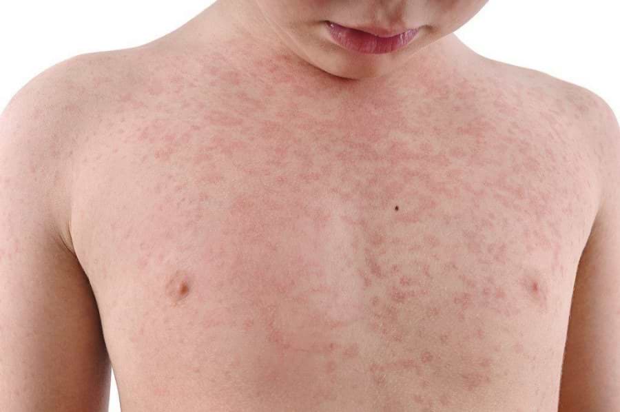 beeetof98's tweet photo. ¿Alguna vez viste estas lesiones en la piel? 👀 ¿Te son familiares? 🤔¿Tenés algún hermanitx, sobrinx u hijx que las presentó alguna vez?👶 Mi nombre es Florentín Alberto estudiante de medicina 🙋‍♂️ junto con @PedIIUNNE y @rjabornisky  te voy a hablar de: urticaria en niños! https://t.co/O3ZotNQjjY