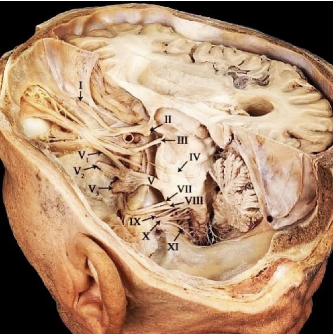 While I don’t recommend this operative approach, it provides a great view of the cranial nerves.