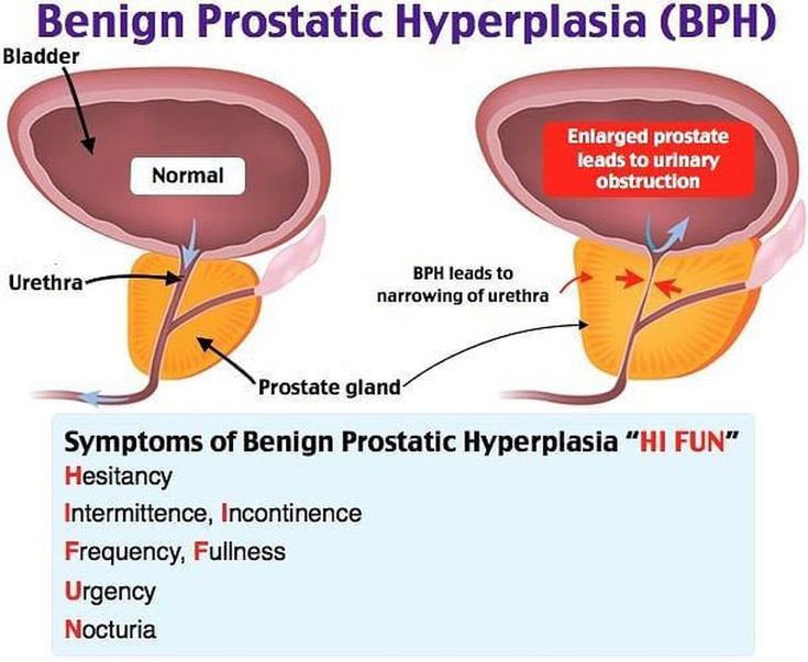 Does low testosterone cause prostate enlargement Does low testosterone cause prostate enlargement