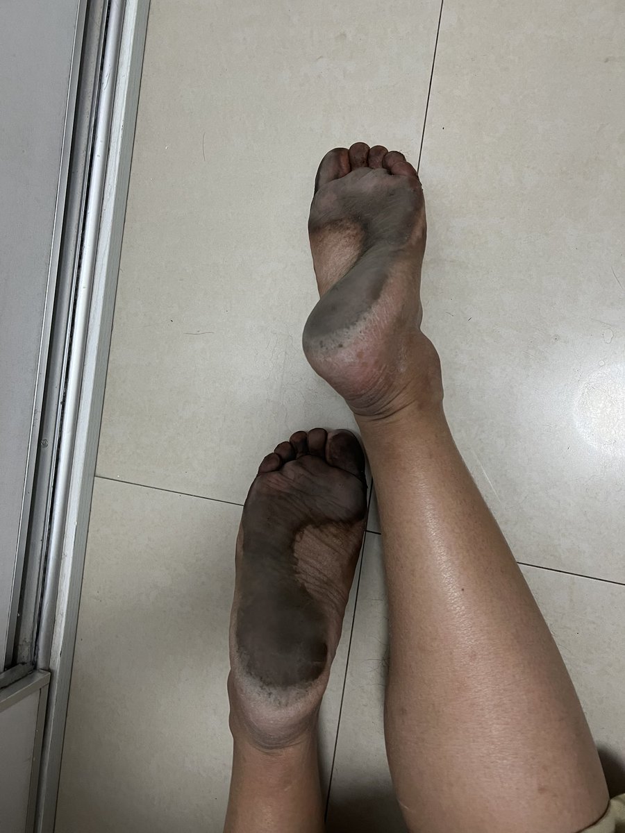 外出一天脚底很黑有没有兰州的小伙伴