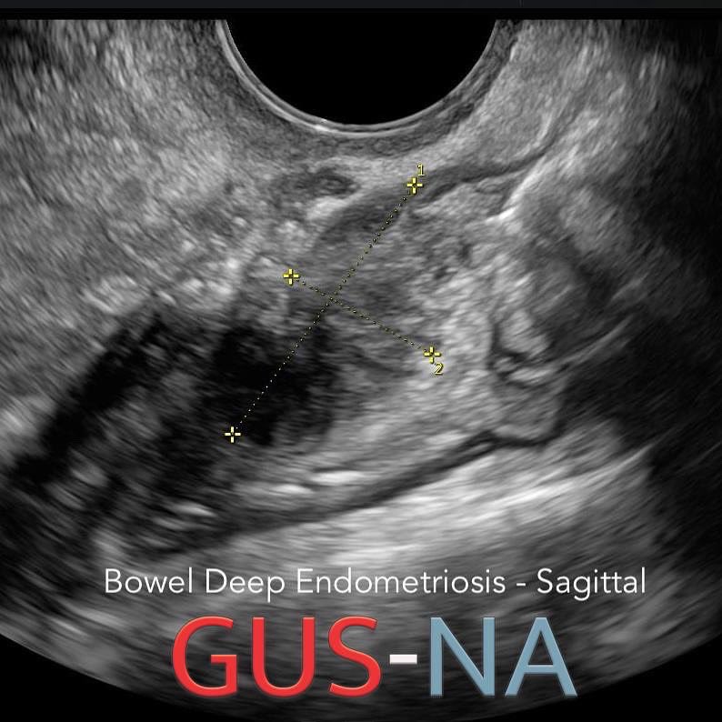 Using transvaginal ultrasound, you can accurately diagnose deep endometriosis. Deep endometriosis most commonly occurs in the posterior compartment of the female pelvis. The most common locations of deep endometriosis are the uterosacral ligaments, torus uterinus, and bowel.