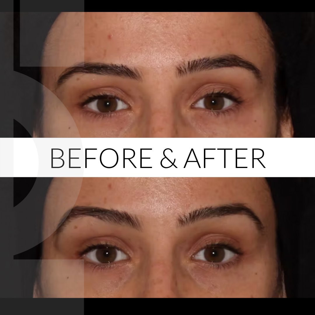 “We can now see that the eyebrows have a much better and more attractive orientation from head up to apex. She looks more refreshed, without looking like she has undergone any procedure.” - Dr Tapan Patel ⁣
⁣
Book your consultation by calling us on 0207 034 5999. ⁣
