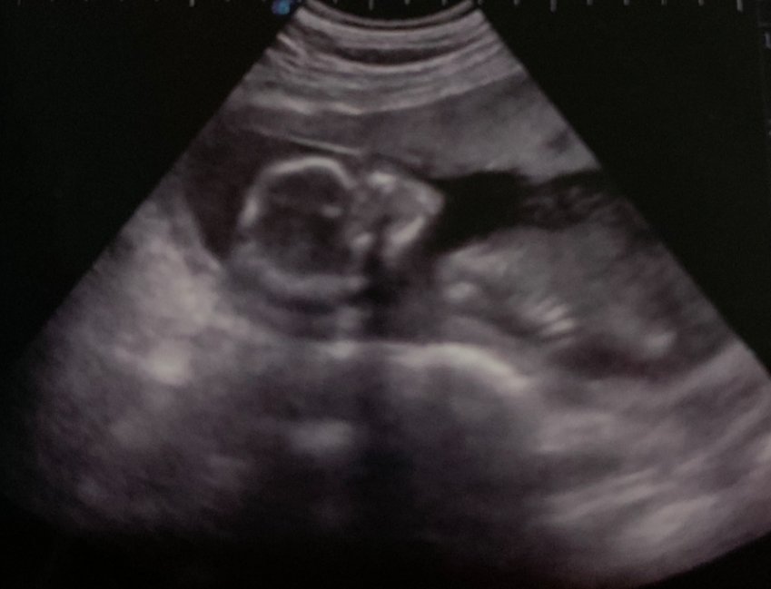 Espero que much@s profesionales que atienden en servicios de obstetricia hayan visto el programa de informe semanal, "No hay latido" ( o lo vean x internet) y reflexionen sobre su "praxis", falta empatía, formación y profesionalidad.
Mucho por hacer todavía!🦋