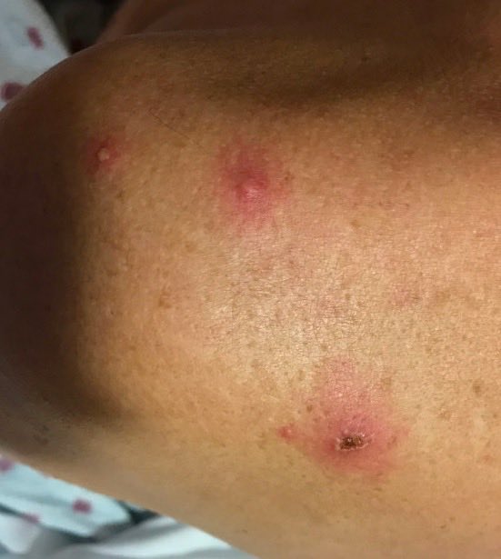 #dermtwitter and #MedTwitter this is NOT #monkeypox - why? #monkeypox lesions are all in the same stage —> cannot have vesicles with nearby crusted papule.
#VZV p/w diff stages of healing as in this presumed case. #dontpanic
