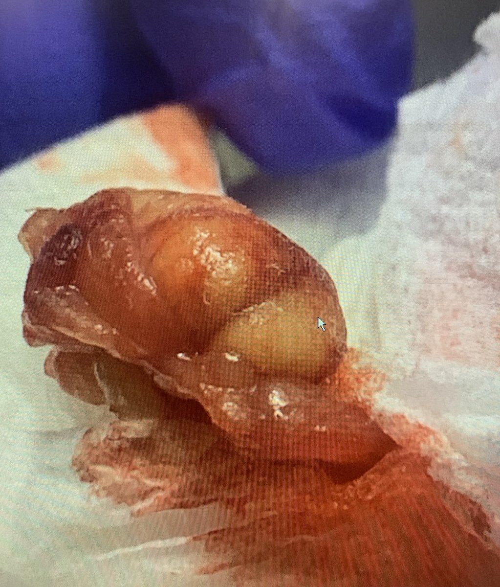 ahorcher's tweet photo. @MDaware @theIDPharmD @jtrebach maybe this is the photo a patient saw before deciding to remove their own tonsil then handing it to me in a paper towel… (they came to the ED w/ CC: sore throat) https://t.co/kU8JXEF5Ox