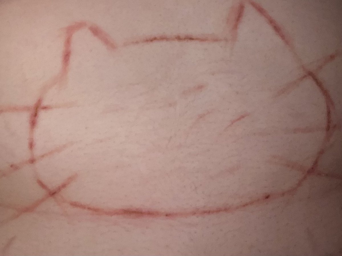 sillykitty92's tweet photo. Infected &amp; healing slowly

*NOT REAL , FAKE , SFX, CGI, THIS PHOTO IS FICTION, FAKE BODY, MAKEUP *
-
shtwt , barcodetwt , catscratchtwt , styrotwt , ouchietwt , armgillstwt , sliceytwt , raspberryfillingtwt , redbreadtwt https://t.co/JHqZv5fHrP