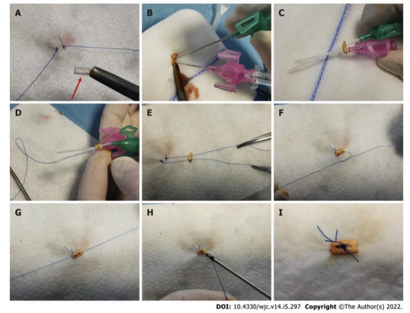 BURZOTTA_F's tweet image. If you are looking for adding surgical techniques to #ProGlide closure, have a look on our ‘PLEDGET-ASSISTED HAEMOSTASIS’ to fix failures! It was really a game changer for our less-invasive totally-endovascular (LITE) #TAVI / #TAVR programme!!! dx.doi.org/10.4330/wjc.v1…